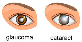 Glaucoma vs cataracts